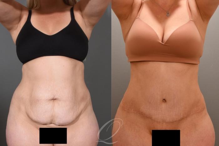 Tummy Tuck Case 1001551 Before & After Front | Serving Rochester, Syracuse & Buffalo, NY | Quatela Center for Plastic Surgery