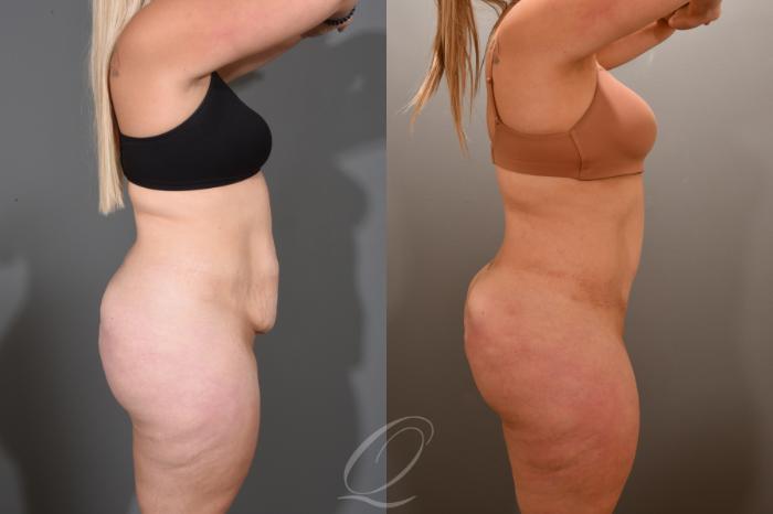 Tummy Tuck Case 1001551 Before & After Right Side | Serving Rochester, Syracuse & Buffalo, NY | Quatela Center for Plastic Surgery