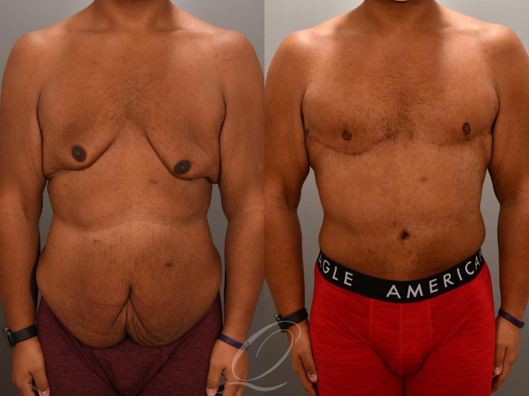 Tummy Tuck Case 1001552 Before & After Front | Serving Rochester, Syracuse & Buffalo, NY | Quatela Center for Plastic Surgery