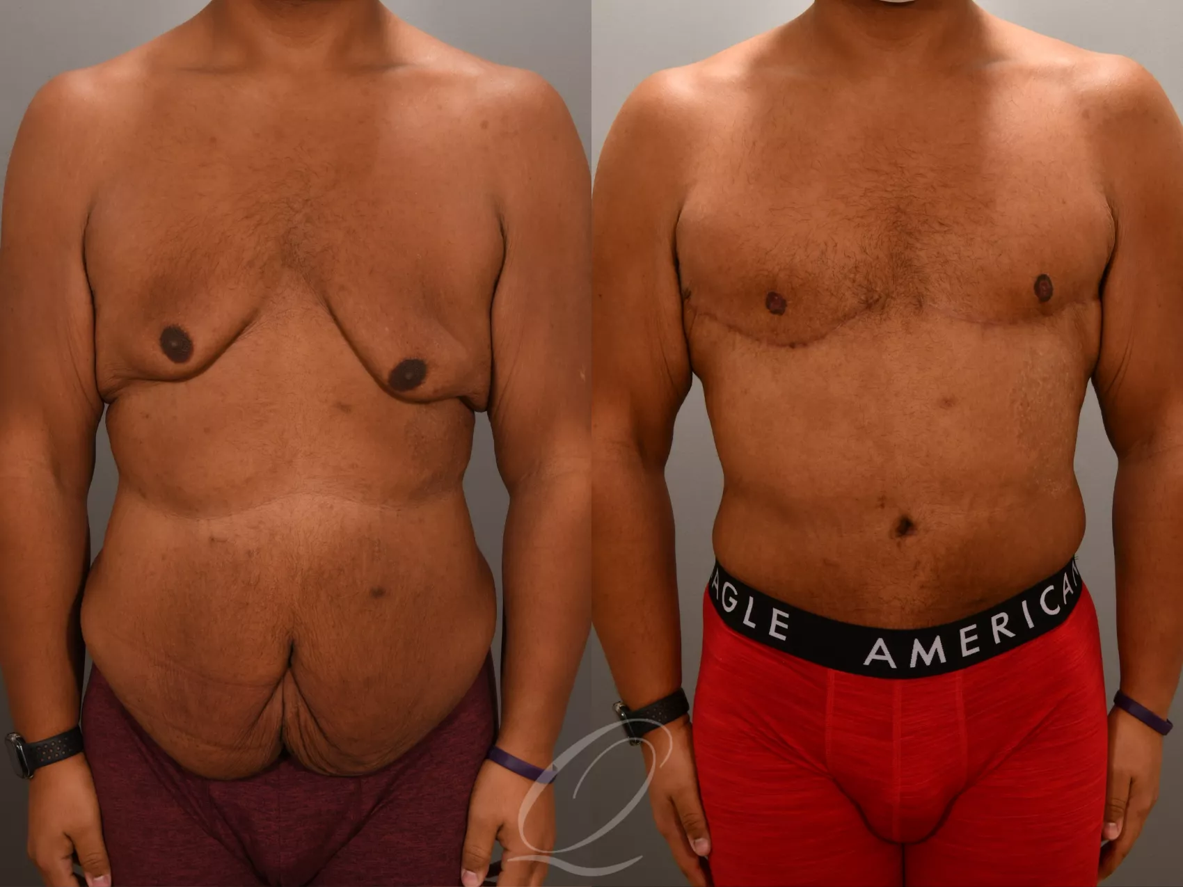 Patient E Body Builder - Pre -Operative Tummy Tuck Frontal Image