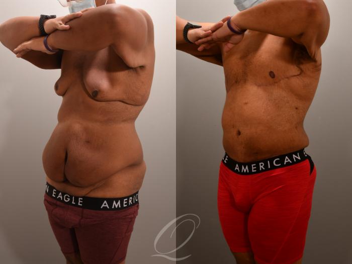 Body Contouring after Weight Loss Case 1001552 Before & After Left Oblique | Serving Rochester, Syracuse & Buffalo, NY | Quatela Center for Plastic Surgery