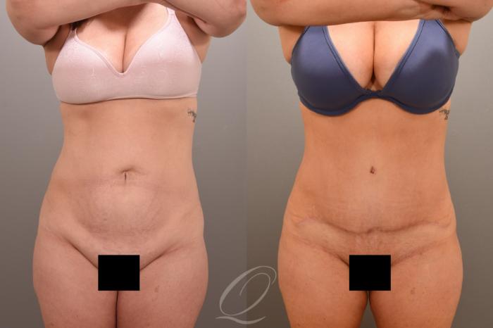 Tummy Tuck Case 1001660 Before & After Front | Serving Rochester, Syracuse & Buffalo, NY | Quatela Center for Plastic Surgery