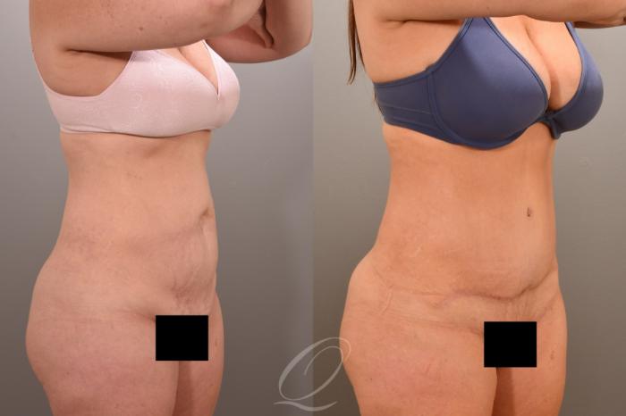 Tummy Tuck Case 1001660 Before & After Right Oblique | Serving Rochester, Syracuse & Buffalo, NY | Quatela Center for Plastic Surgery