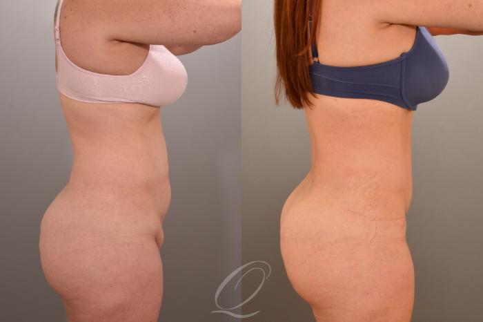 Tummy Tuck Case 1001660 Before & After Right Side | Serving Rochester, Syracuse & Buffalo, NY | Quatela Center for Plastic Surgery