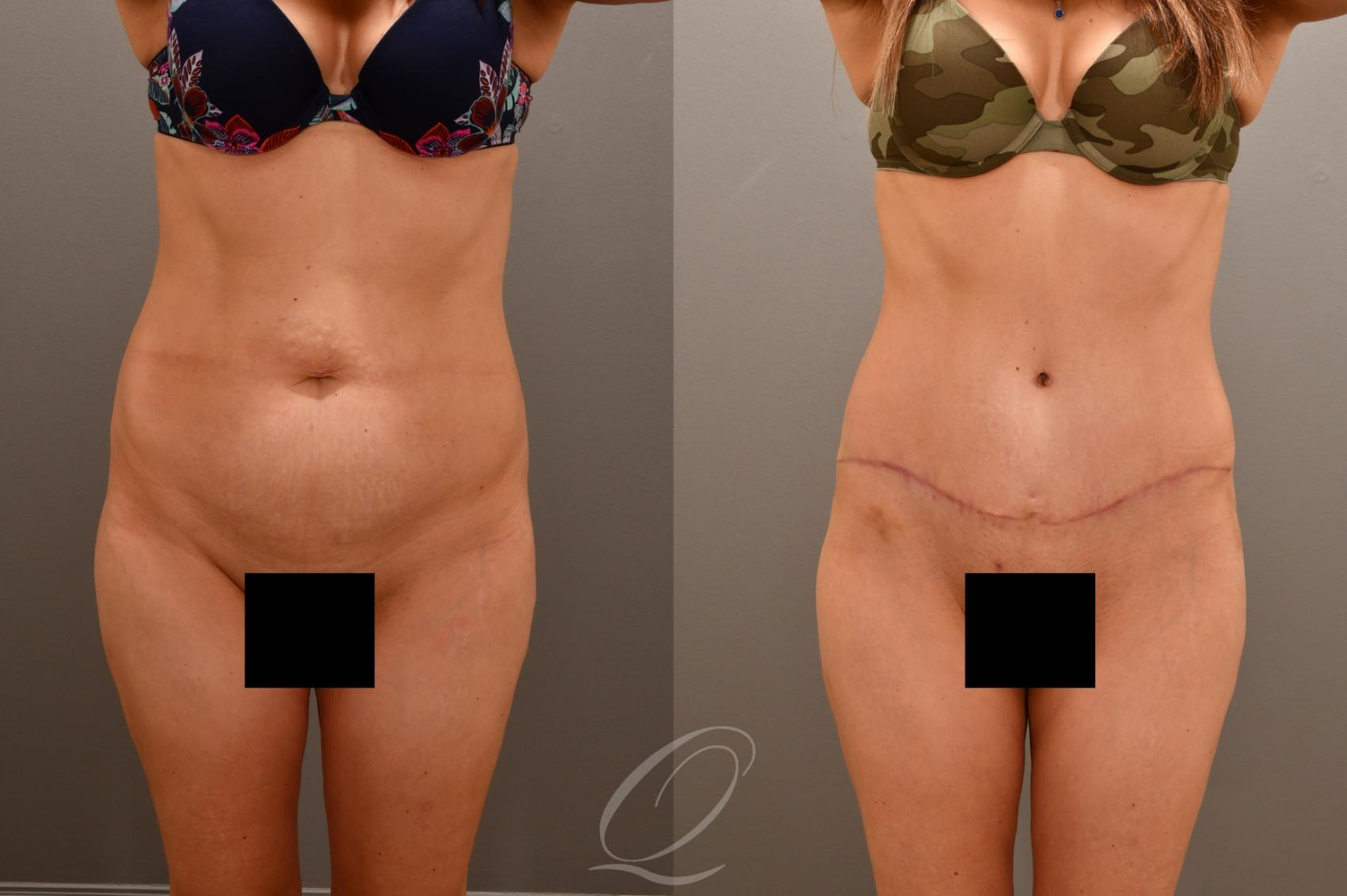 Tummy Tuck Case 1001665 Before & After Front | Serving Rochester, Syracuse & Buffalo, NY | Quatela Center for Plastic Surgery