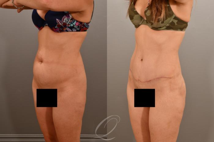 Tummy Tuck Case 1001665 Before & After Left Oblique | Serving Rochester, Syracuse & Buffalo, NY | Quatela Center for Plastic Surgery
