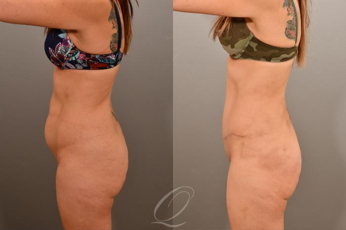 Tummy Tuck Case 1001665 Before & After Left Side | Serving Rochester, Syracuse & Buffalo, NY | Quatela Center for Plastic Surgery
