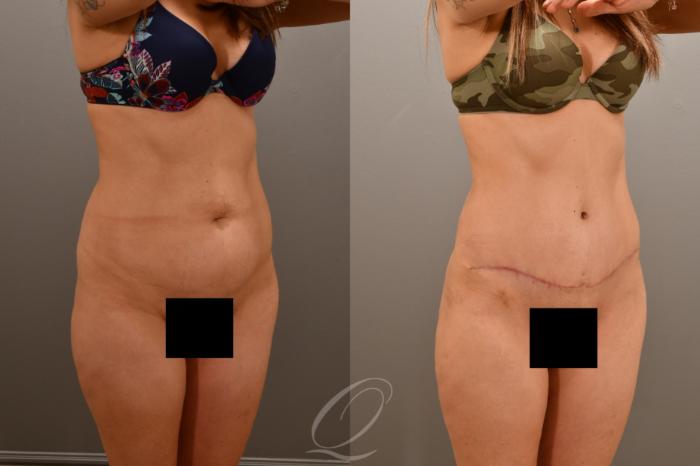 Tummy Tuck Case 1001665 Before & After Right Oblique | Serving Rochester, Syracuse & Buffalo, NY | Quatela Center for Plastic Surgery