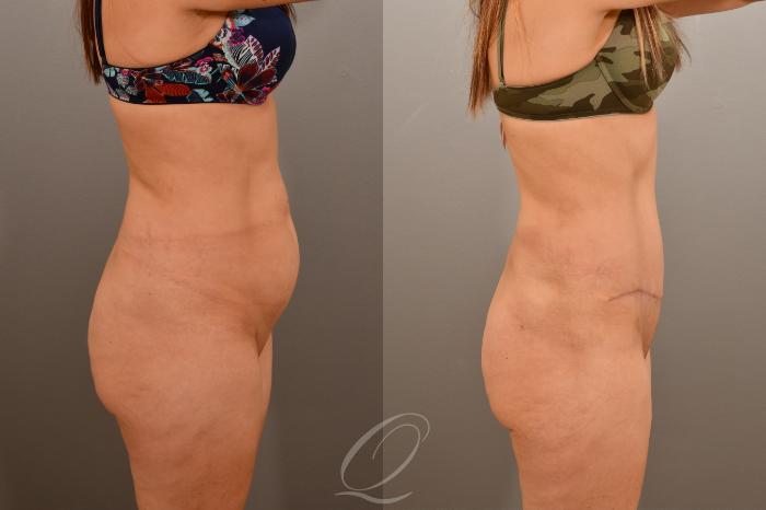 Tummy Tuck Case 1001665 Before & After Right Side | Serving Rochester, Syracuse & Buffalo, NY | Quatela Center for Plastic Surgery