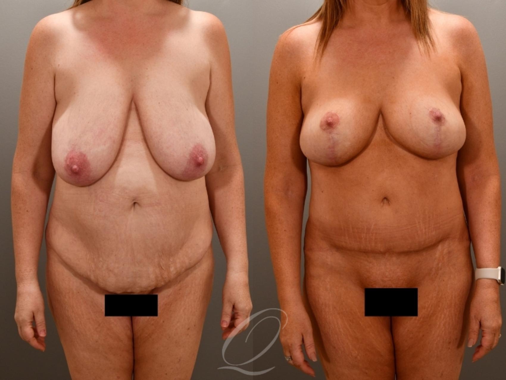 Tummy Tuck Case 1001772 Before & After Front | Serving Rochester, Syracuse & Buffalo, NY | Quatela Center for Plastic Surgery