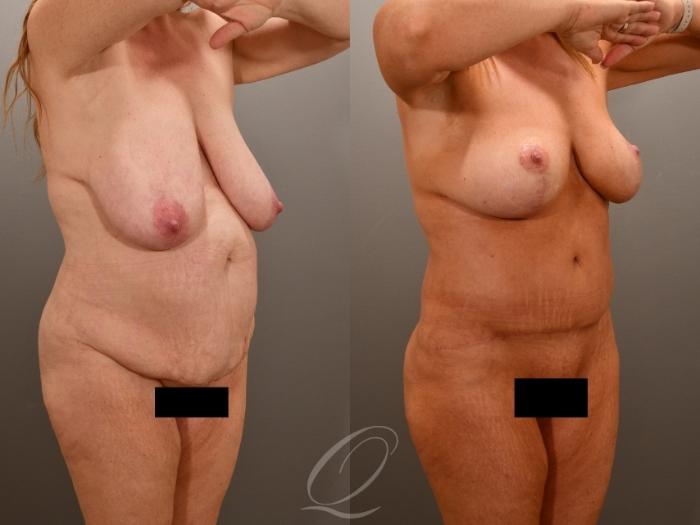 Tummy Tuck Case 1001772 Before & After Left Oblique | Serving Rochester, Syracuse & Buffalo, NY | Quatela Center for Plastic Surgery