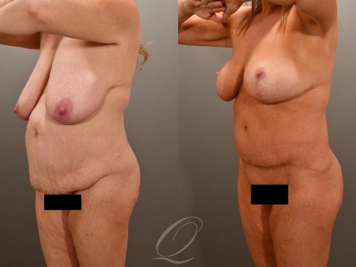 Tummy Tuck Case 1001772 Before & After Right Oblique | Serving Rochester, Syracuse & Buffalo, NY | Quatela Center for Plastic Surgery