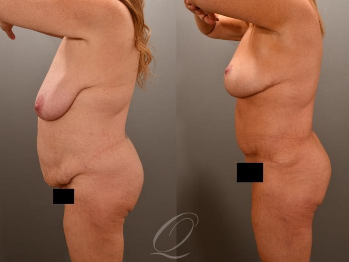 Tummy Tuck Case 1001772 Before & After Right Side | Serving Rochester, Syracuse & Buffalo, NY | Quatela Center for Plastic Surgery