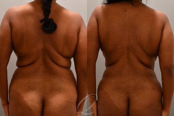 Tummy Tuck Case 1001804 Before & After Back | Serving Rochester, Syracuse & Buffalo, NY | Quatela Center for Plastic Surgery