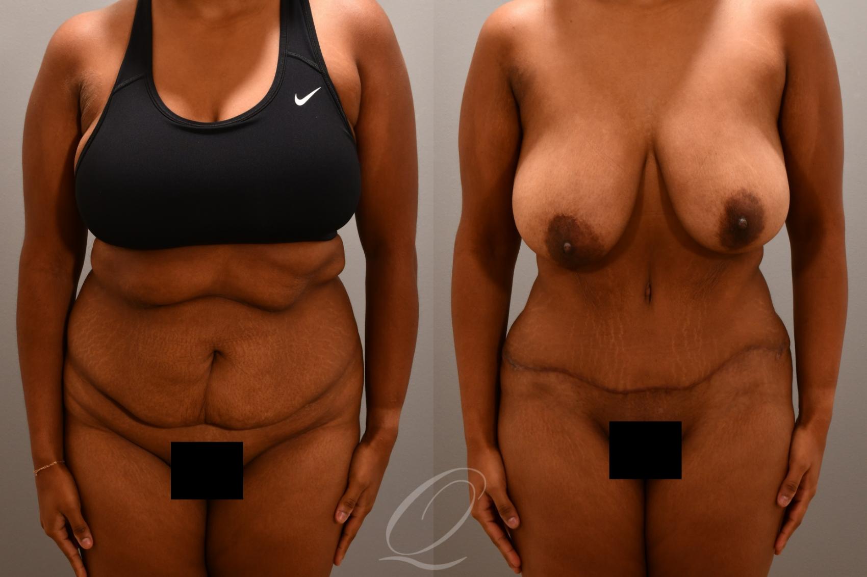 Tummy Tuck Case 1001804 Before & After Front | Serving Rochester, Syracuse & Buffalo, NY | Quatela Center for Plastic Surgery