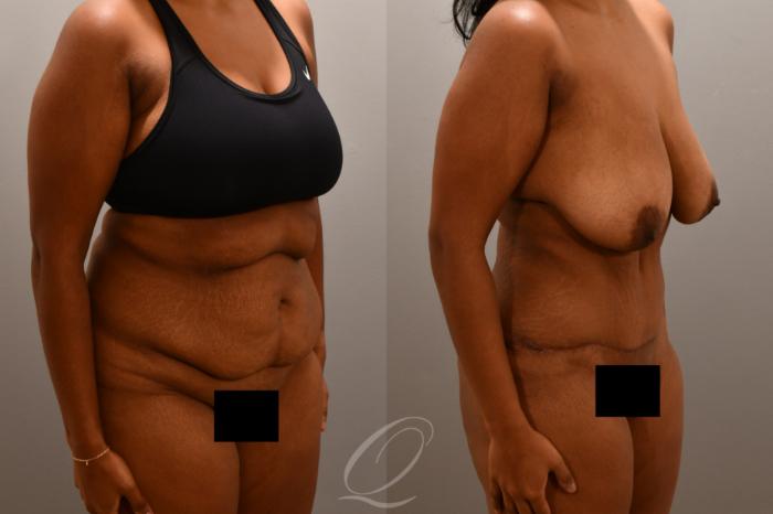 Tummy Tuck Case 1001804 Before & After Right Oblique | Serving Rochester, Syracuse & Buffalo, NY | Quatela Center for Plastic Surgery