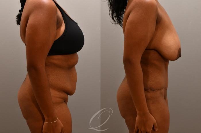 Tummy Tuck Case 1001804 Before & After Right Side | Serving Rochester, Syracuse & Buffalo, NY | Quatela Center for Plastic Surgery