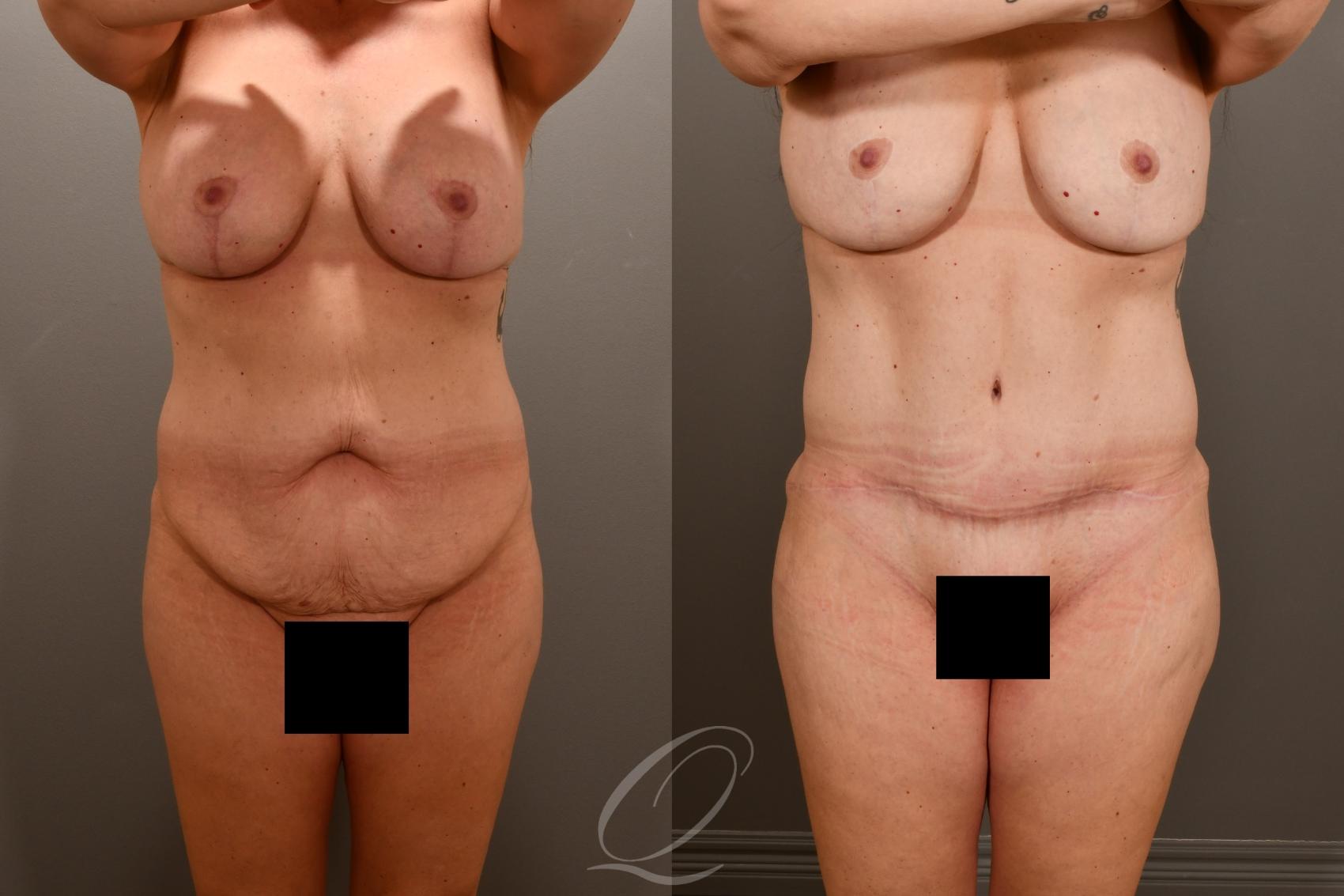 Tummy Tuck Case 1001857 Before & After Front | Serving Rochester, Syracuse & Buffalo, NY | Quatela Center for Plastic Surgery