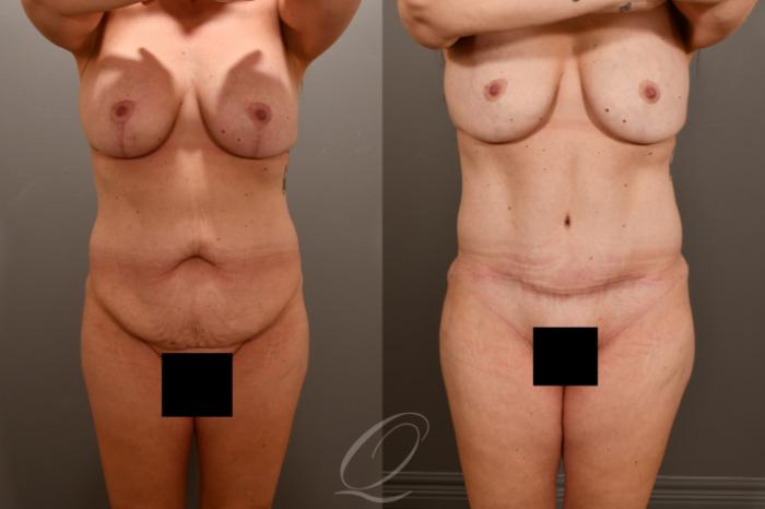 Tummy Tuck Case 1001857 Before & After Front | Serving Rochester, Syracuse & Buffalo, NY | Quatela Center for Plastic Surgery