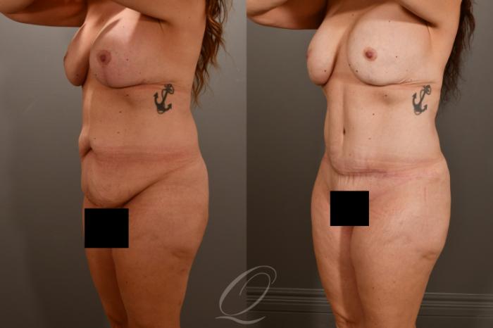 Tummy Tuck Case 1001857 Before & After Left Oblique | Serving Rochester, Syracuse & Buffalo, NY | Quatela Center for Plastic Surgery