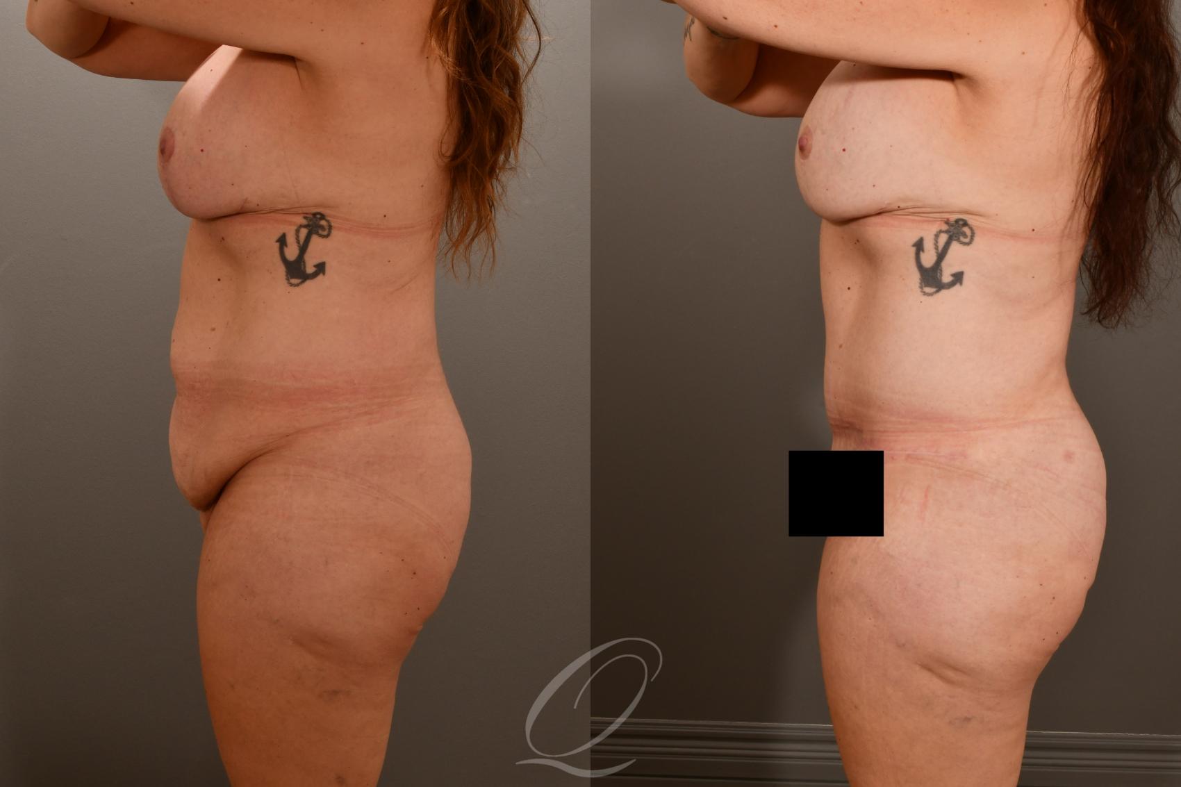 Tummy Tuck Case 1001857 Before & After Left Side | Serving Rochester, Syracuse & Buffalo, NY | Quatela Center for Plastic Surgery