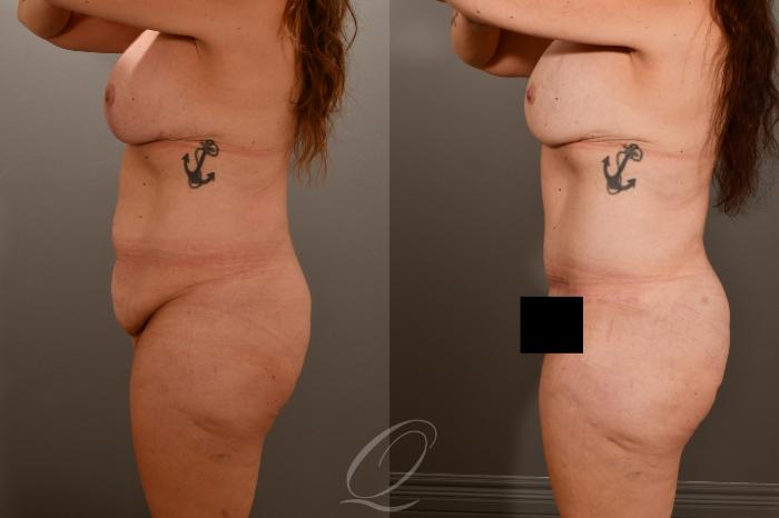 Tummy Tuck Case 1001857 Before & After Left Side | Serving Rochester, Syracuse & Buffalo, NY | Quatela Center for Plastic Surgery