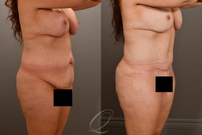 Tummy Tuck Case 1001857 Before & After Right Oblique | Serving Rochester, Syracuse & Buffalo, NY | Quatela Center for Plastic Surgery