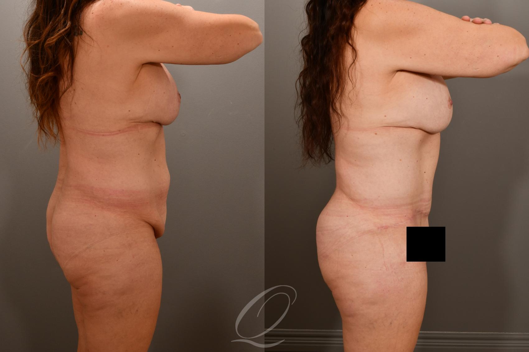 Tummy Tuck Case 1001857 Before & After Right Side | Serving Rochester, Syracuse & Buffalo, NY | Quatela Center for Plastic Surgery
