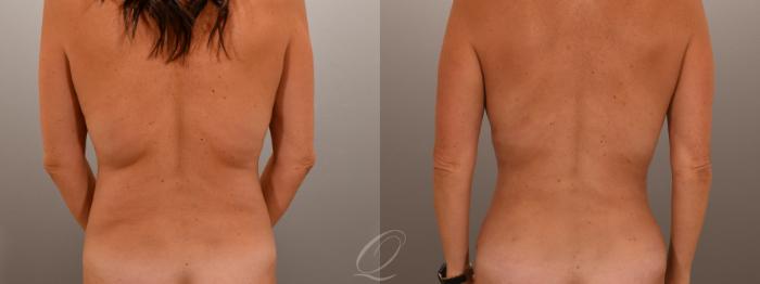 Tummy Tuck Case 1001874 Before & After Back | Serving Rochester, Syracuse & Buffalo, NY | Quatela Center for Plastic Surgery