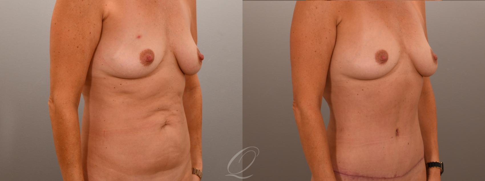 Tummy Tuck Case 1001874 Before & After Left Oblique | Serving Rochester, Syracuse & Buffalo, NY | Quatela Center for Plastic Surgery