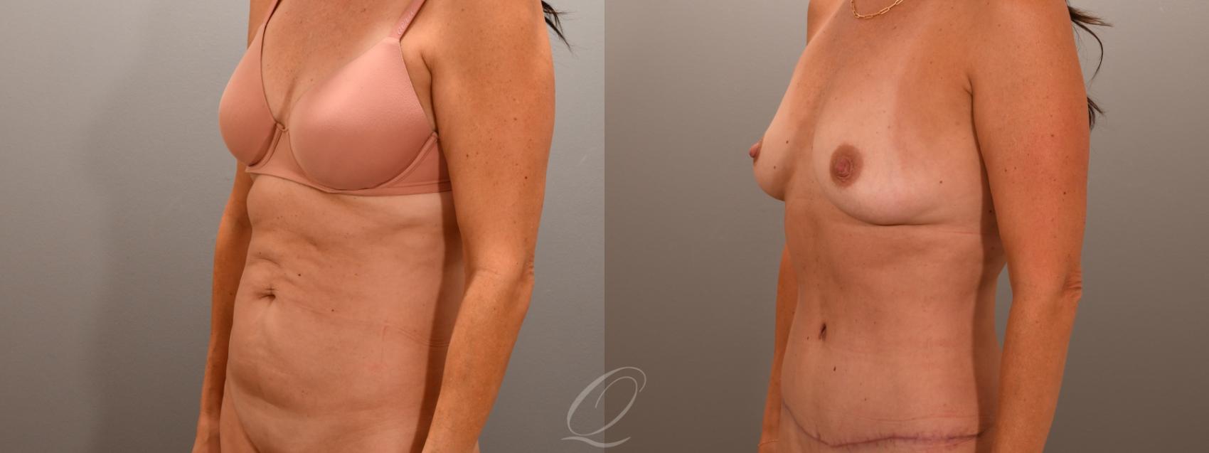 Tummy Tuck Case 1001874 Before & After Right Oblique | Serving Rochester, Syracuse & Buffalo, NY | Quatela Center for Plastic Surgery