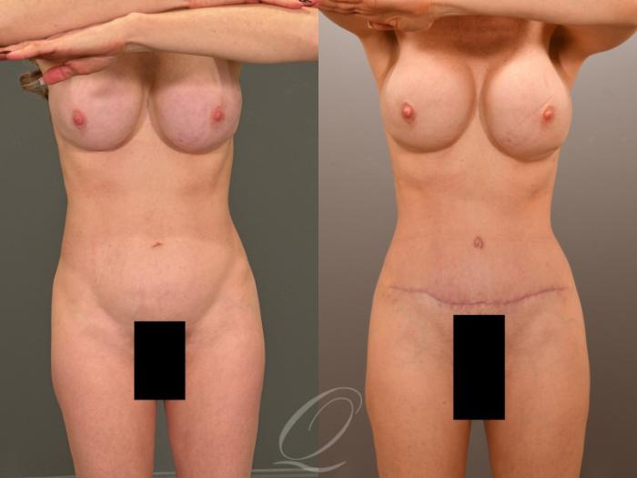 Tummy Tuck Case 1001901 Before & After Front | Serving Rochester, Syracuse & Buffalo, NY | Quatela Center for Plastic Surgery