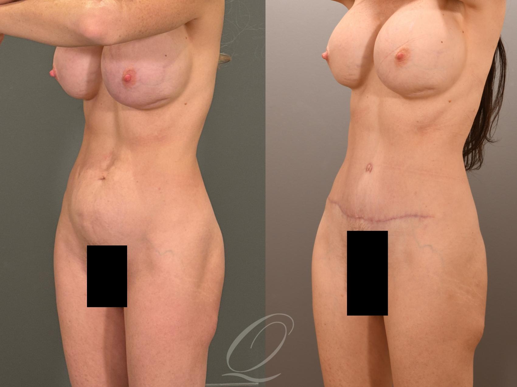 Tummy Tuck Case 1001901 Before & After Left Oblique | Serving Rochester, Syracuse & Buffalo, NY | Quatela Center for Plastic Surgery