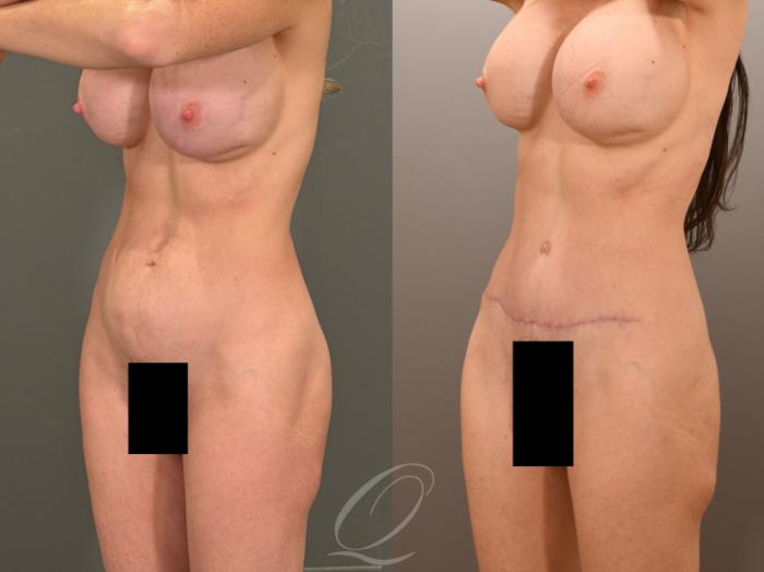 Tummy Tuck Case 1001901 Before & After Left Oblique | Serving Rochester, Syracuse & Buffalo, NY | Quatela Center for Plastic Surgery