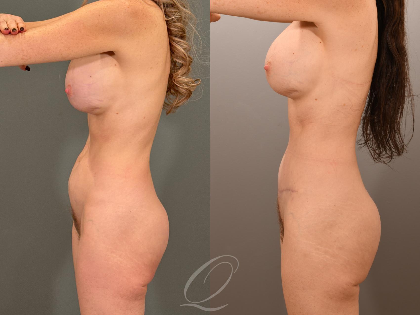 Tummy Tuck Case 1001901 Before & After Left Side | Serving Rochester, Syracuse & Buffalo, NY | Quatela Center for Plastic Surgery