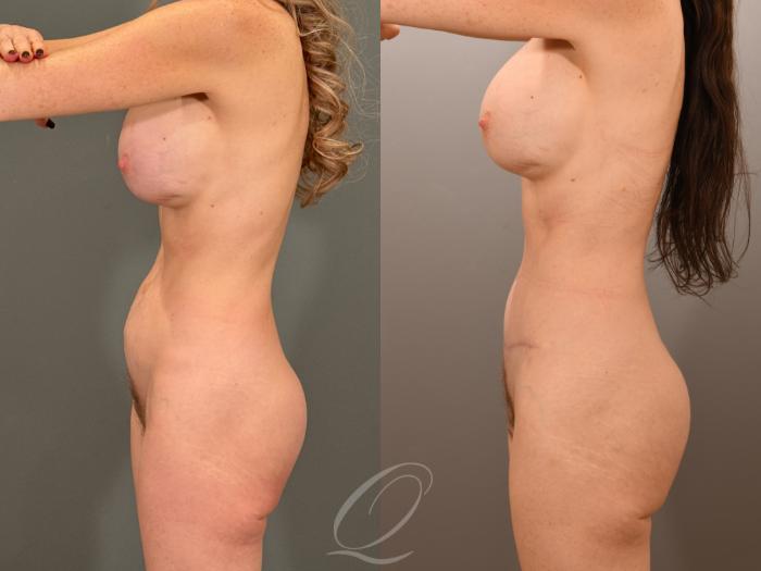 Tummy Tuck Case 1001901 Before & After Left Side | Serving Rochester, Syracuse & Buffalo, NY | Quatela Center for Plastic Surgery