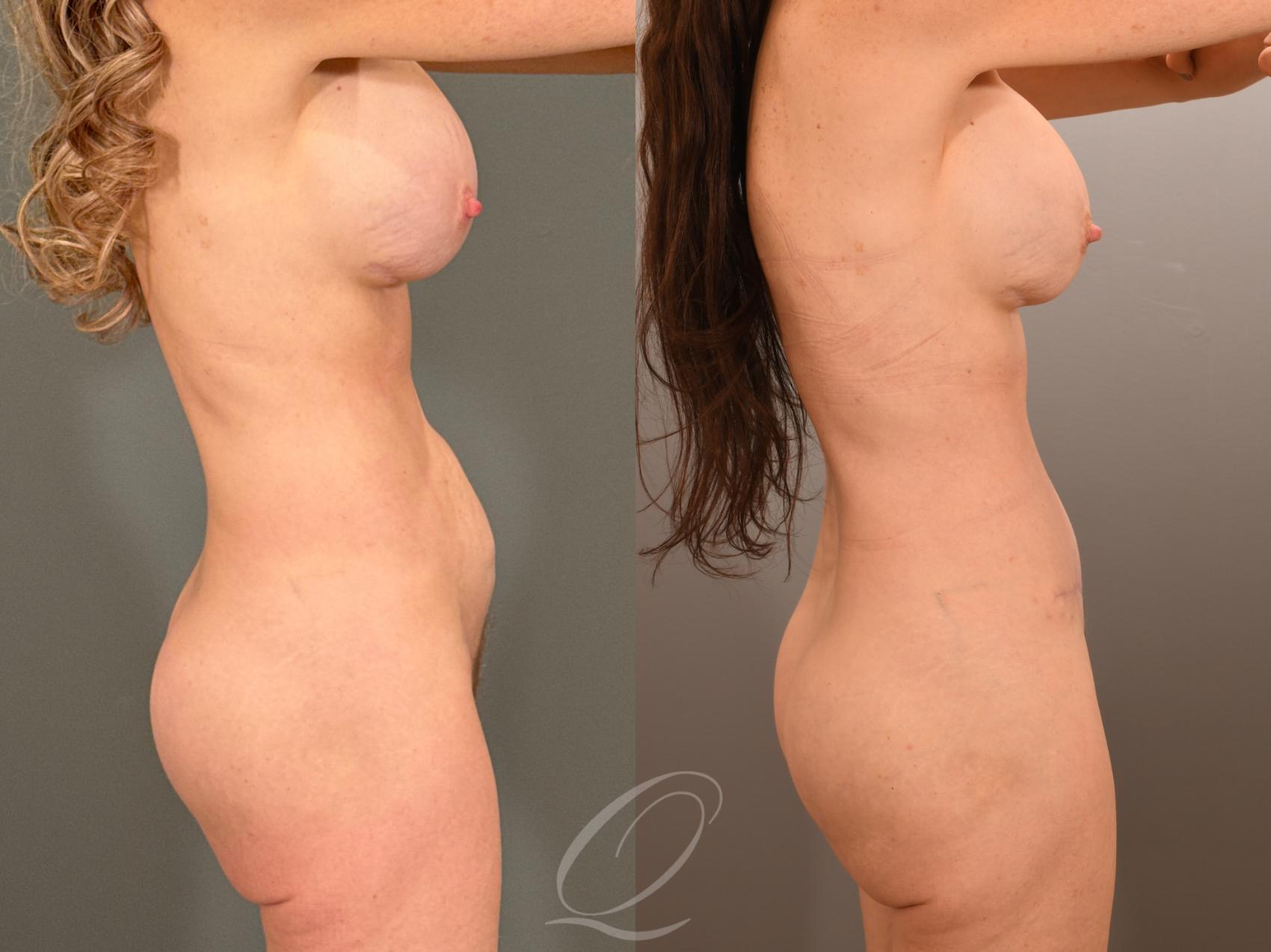 Tummy Tuck Case 1001901 Before & After Right Side | Serving Rochester, Syracuse & Buffalo, NY | Quatela Center for Plastic Surgery