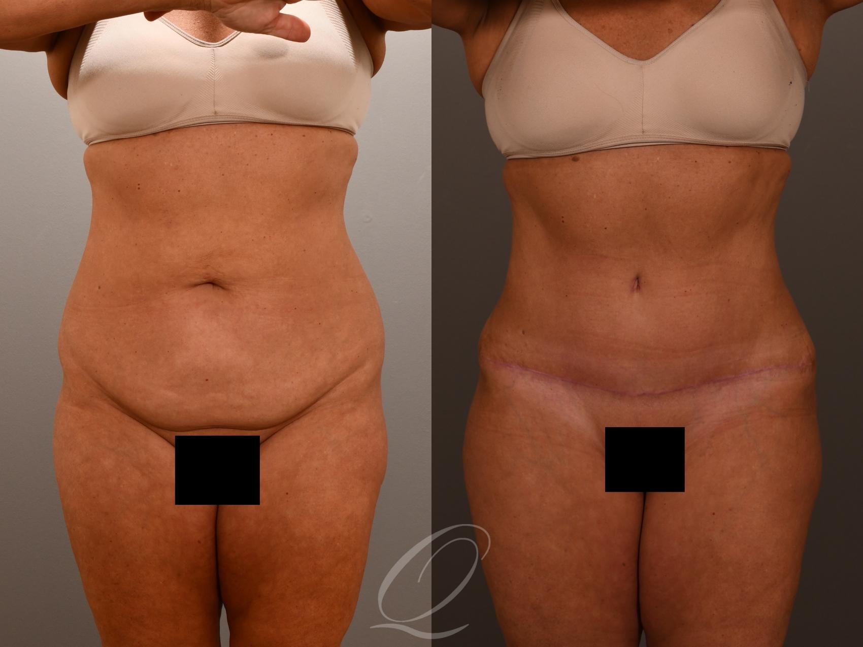 Renuvion Skin Tightening Treatment Case 1001902 Before & After Front | Serving Rochester, Syracuse & Buffalo, NY | Quatela Center for Plastic Surgery