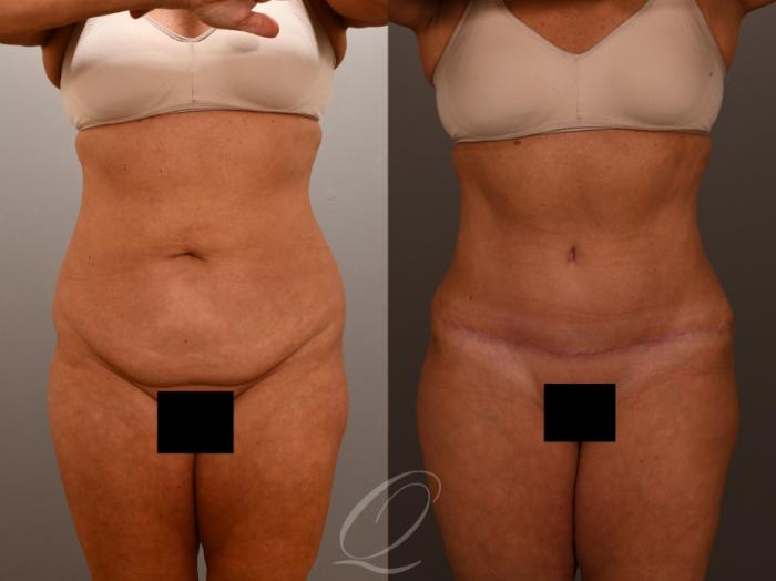 Liposuction Case 1001902 Before & After Front | Serving Rochester, Syracuse & Buffalo, NY | Quatela Center for Plastic Surgery