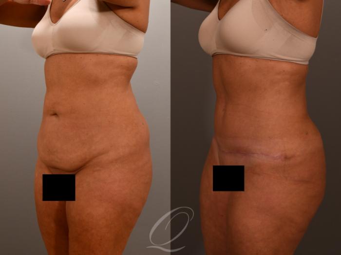 Renuvion Skin Tightening Treatment Case 1001902 Before & After Left Oblique | Serving Rochester, Syracuse & Buffalo, NY | Quatela Center for Plastic Surgery