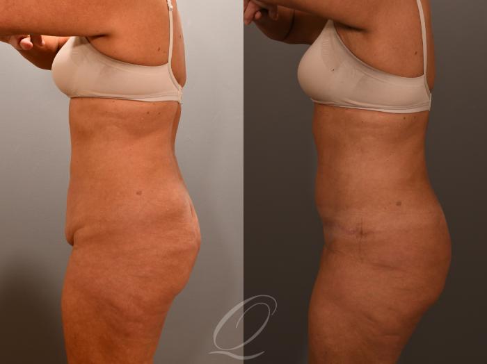 Renuvion Skin Tightening Treatment Case 1001902 Before & After Left Side | Serving Rochester, Syracuse & Buffalo, NY | Quatela Center for Plastic Surgery