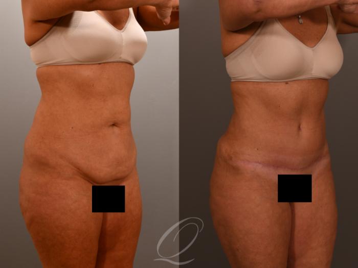 Renuvion Skin Tightening Treatment Case 1001902 Before & After Right Oblique | Serving Rochester, Syracuse & Buffalo, NY | Quatela Center for Plastic Surgery