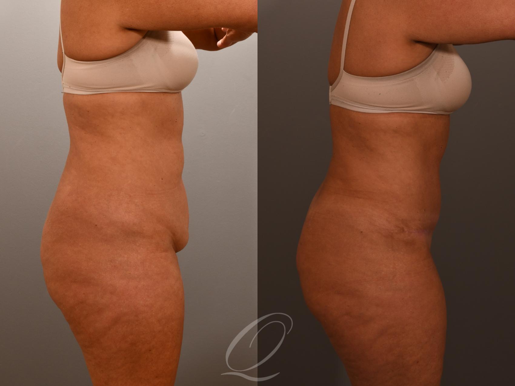 Renuvion Skin Tightening Treatment Case 1001902 Before & After Right Side | Serving Rochester, Syracuse & Buffalo, NY | Quatela Center for Plastic Surgery