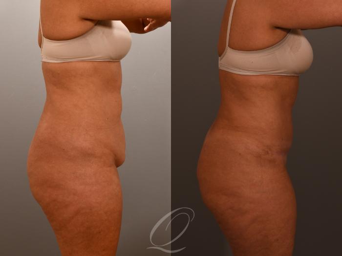 Renuvion Skin Tightening Treatment Case 1001902 Before & After Right Side | Serving Rochester, Syracuse & Buffalo, NY | Quatela Center for Plastic Surgery