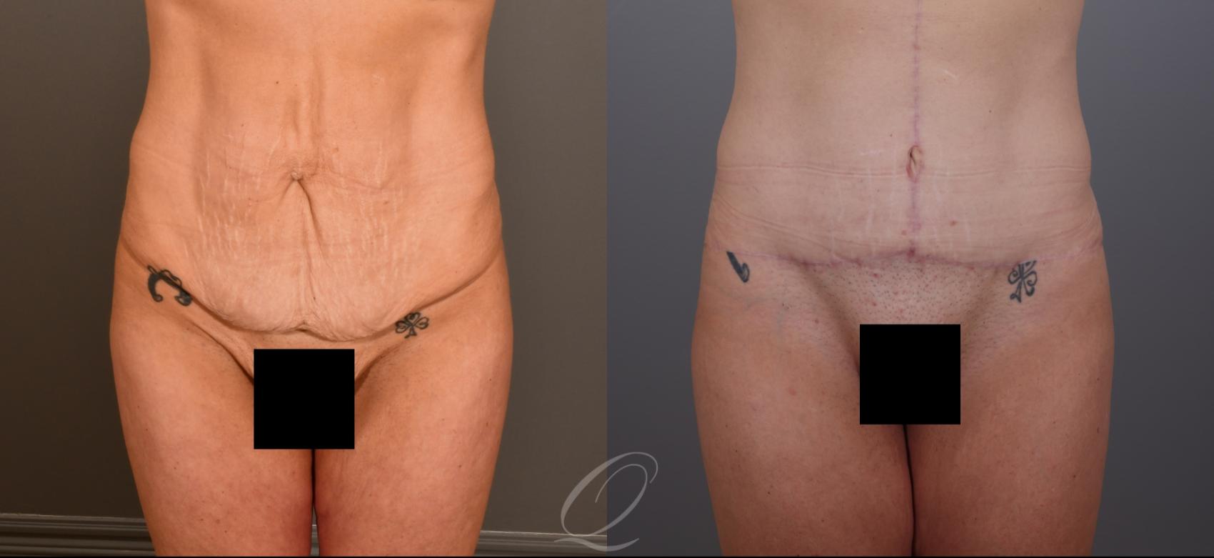Tummy Tuck Case 1001906 Before & After Front | Serving Rochester, Syracuse & Buffalo, NY | Quatela Center for Plastic Surgery