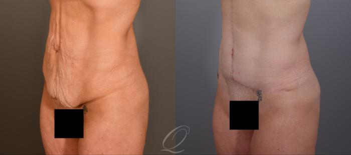 Tummy Tuck Case 1001906 Before & After Left Oblique | Serving Rochester, Syracuse & Buffalo, NY | Quatela Center for Plastic Surgery