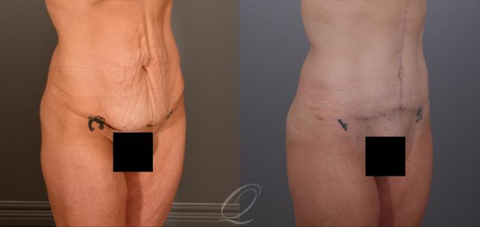 Tummy Tuck Case 1001906 Before & After Right Oblique | Serving Rochester, Syracuse & Buffalo, NY | Quatela Center for Plastic Surgery
