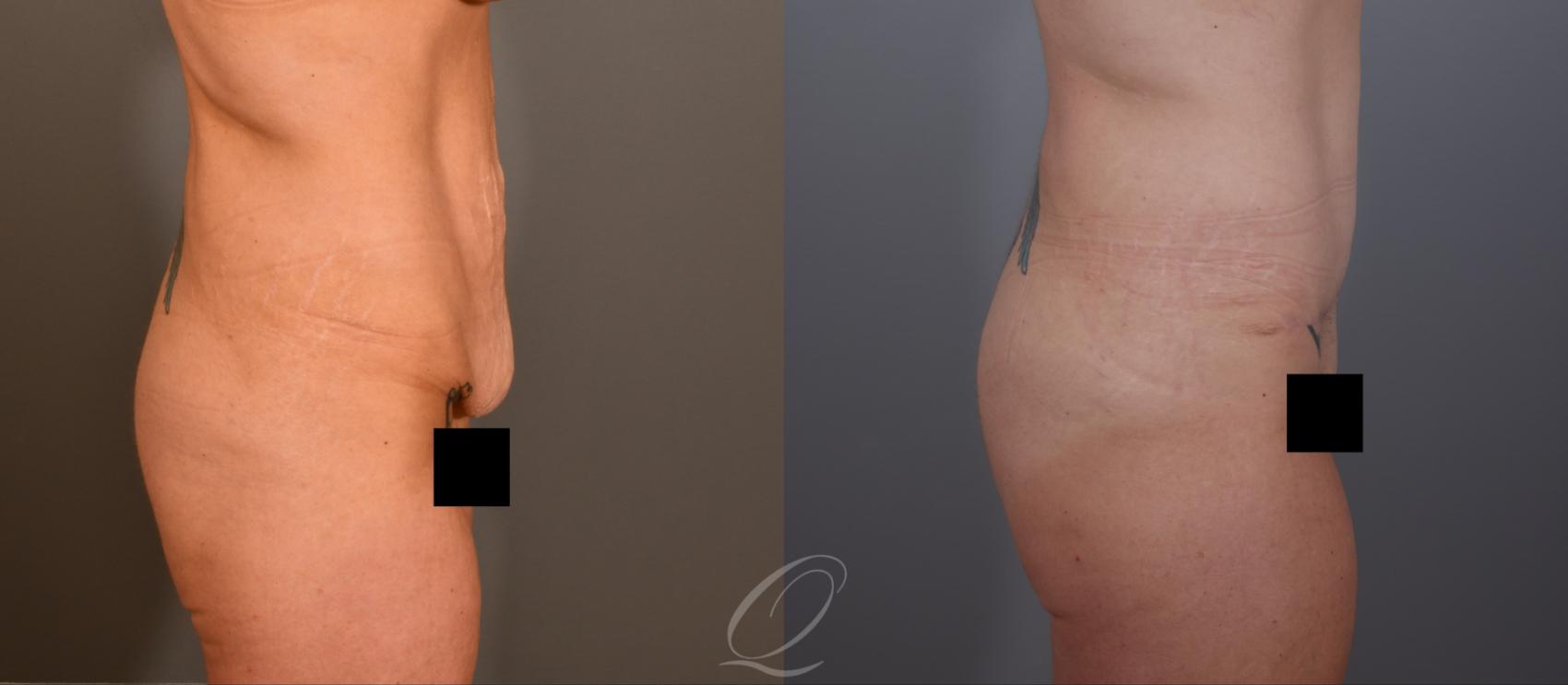 Tummy Tuck Case 1001906 Before & After Right Side | Serving Rochester, Syracuse & Buffalo, NY | Quatela Center for Plastic Surgery