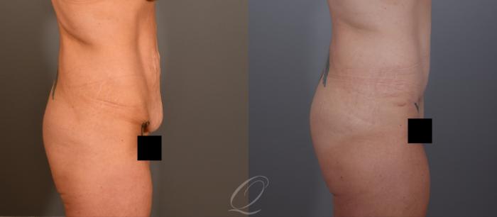 Tummy Tuck Case 1001906 Before & After Right Side | Serving Rochester, Syracuse & Buffalo, NY | Quatela Center for Plastic Surgery