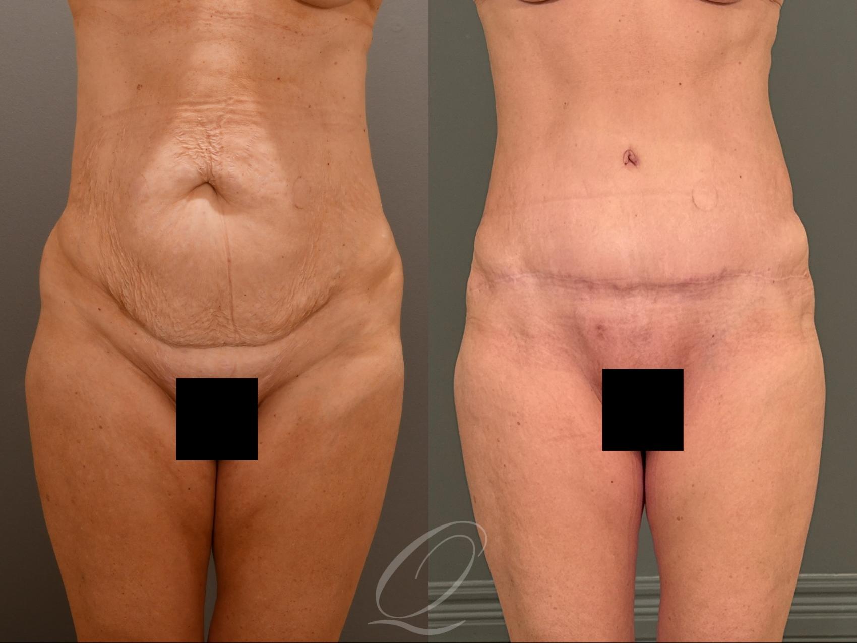 Tummy Tuck Case 1001908 Before & After Front | Serving Rochester, Syracuse & Buffalo, NY | Quatela Center for Plastic Surgery